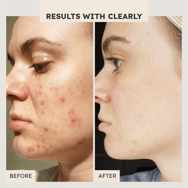 Clear Complexion System