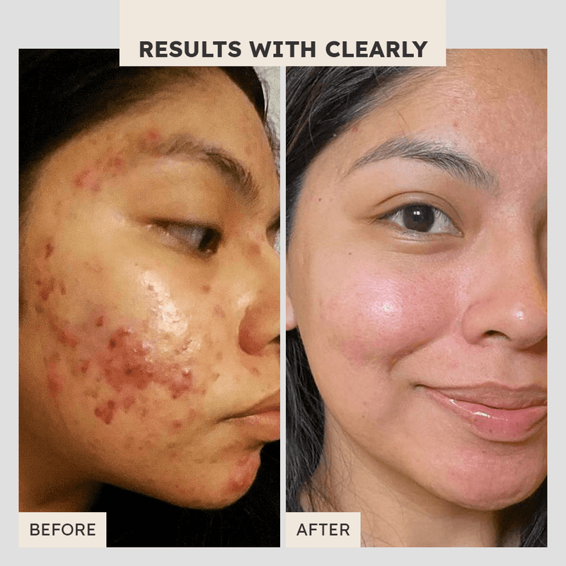 Acne Defense Duo